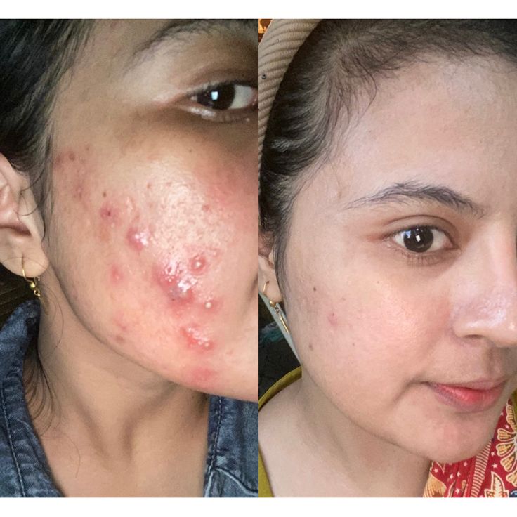 The Ordinary™ Niacinamide 10% + Zinc 1%